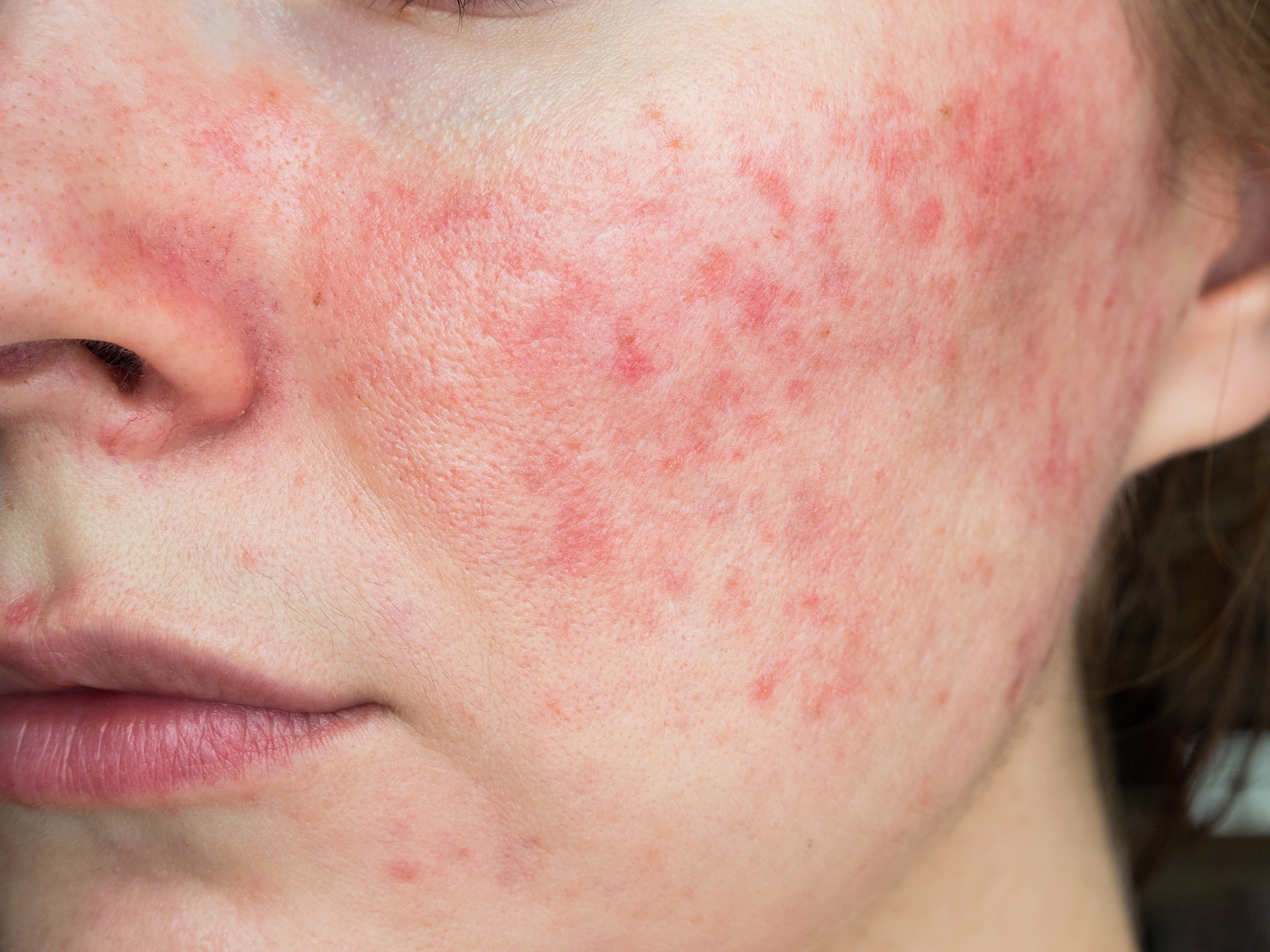 Hyperpigmentation and Rosacea